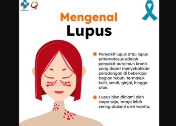Gejala Lupus yang Wajib Diwaspadai, Wanita Harus Tahu