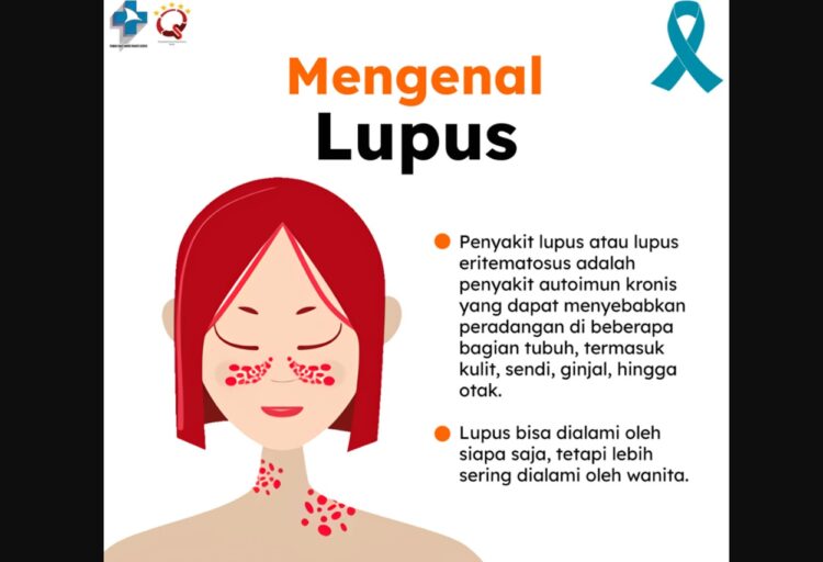 Gejala Lupus yang Wajib Diwaspadai, Wanita Harus Tahu
