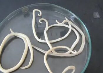 Bagaimana Bisa Cacing dari Usus Menyerang Otak dan Paru-Paru Bocah Sukabumi?, Begini Penjelasan Dokter Ahli