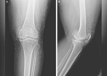 benang emas di lutut pasien