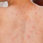 kasus campak Pamekasan